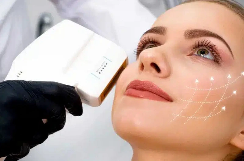 Công nghệ Hifu giúp nâng cơ mặt tự nhiên (Ảnh: benhvienthammynaman)