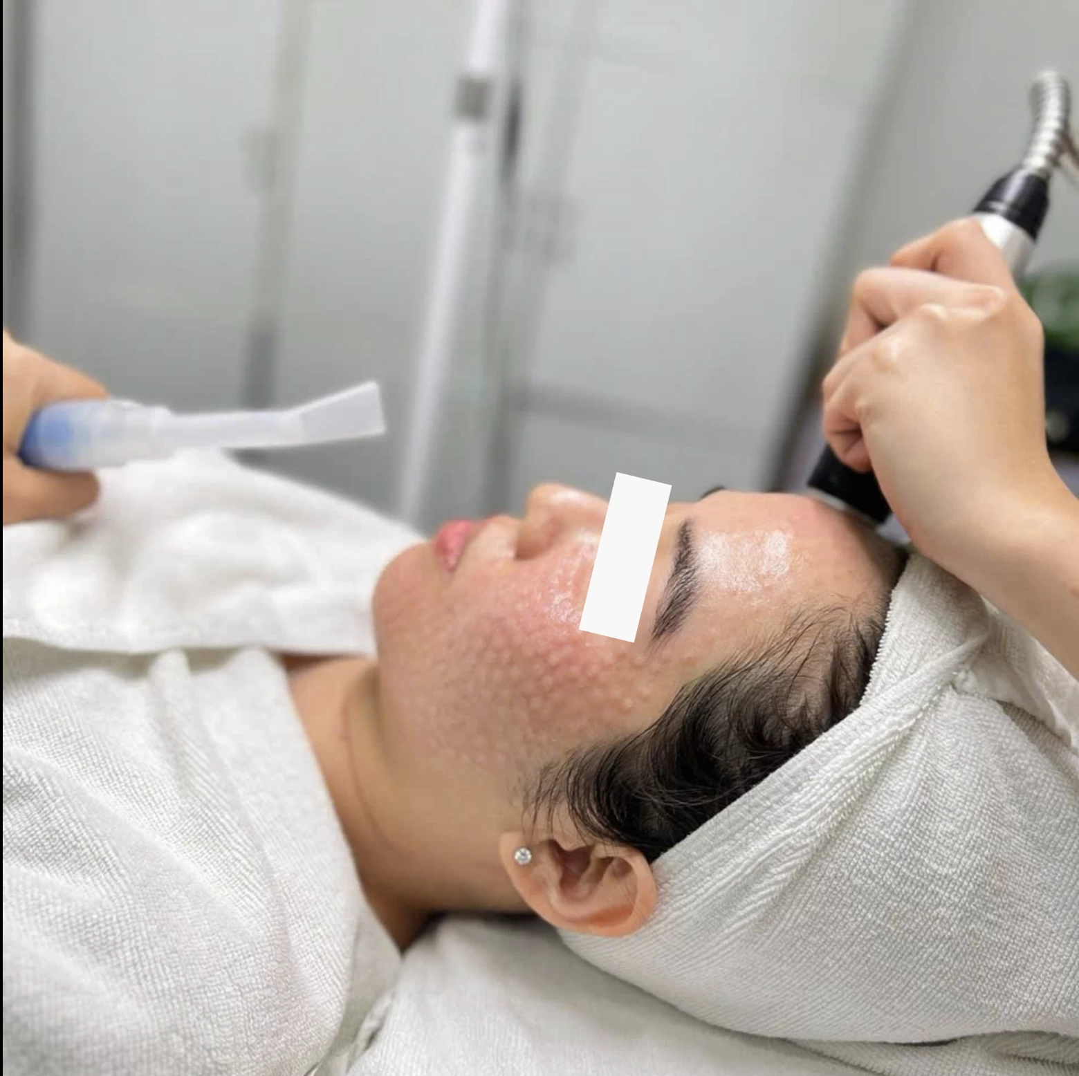 Đây là minh chứng của Glow Face 2.0 khi trẻ hóa da toàn diện, sử dụng công nghệ HIFU hiện đại để thu nhỏ lỗ chân lông và nâng cao hiệu quả của liệu trình chăm sóc da.